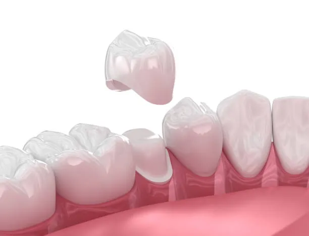 Dental Crowns at home in Hyderabad – Prudentoe