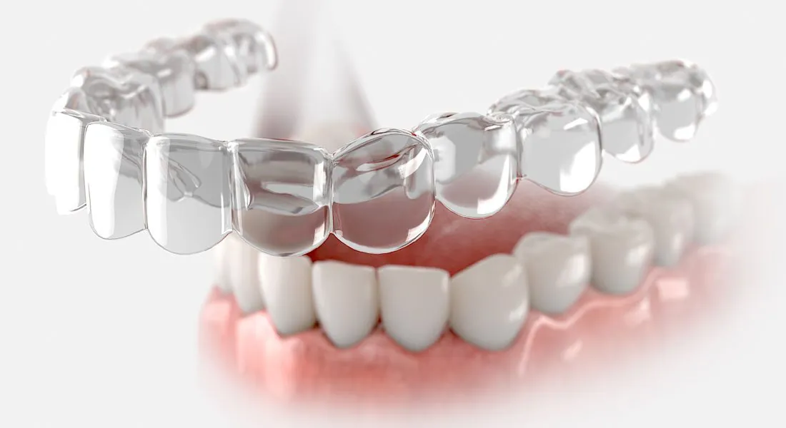 Prudentoe Aligners & Invisalign home visit in Hyderabad