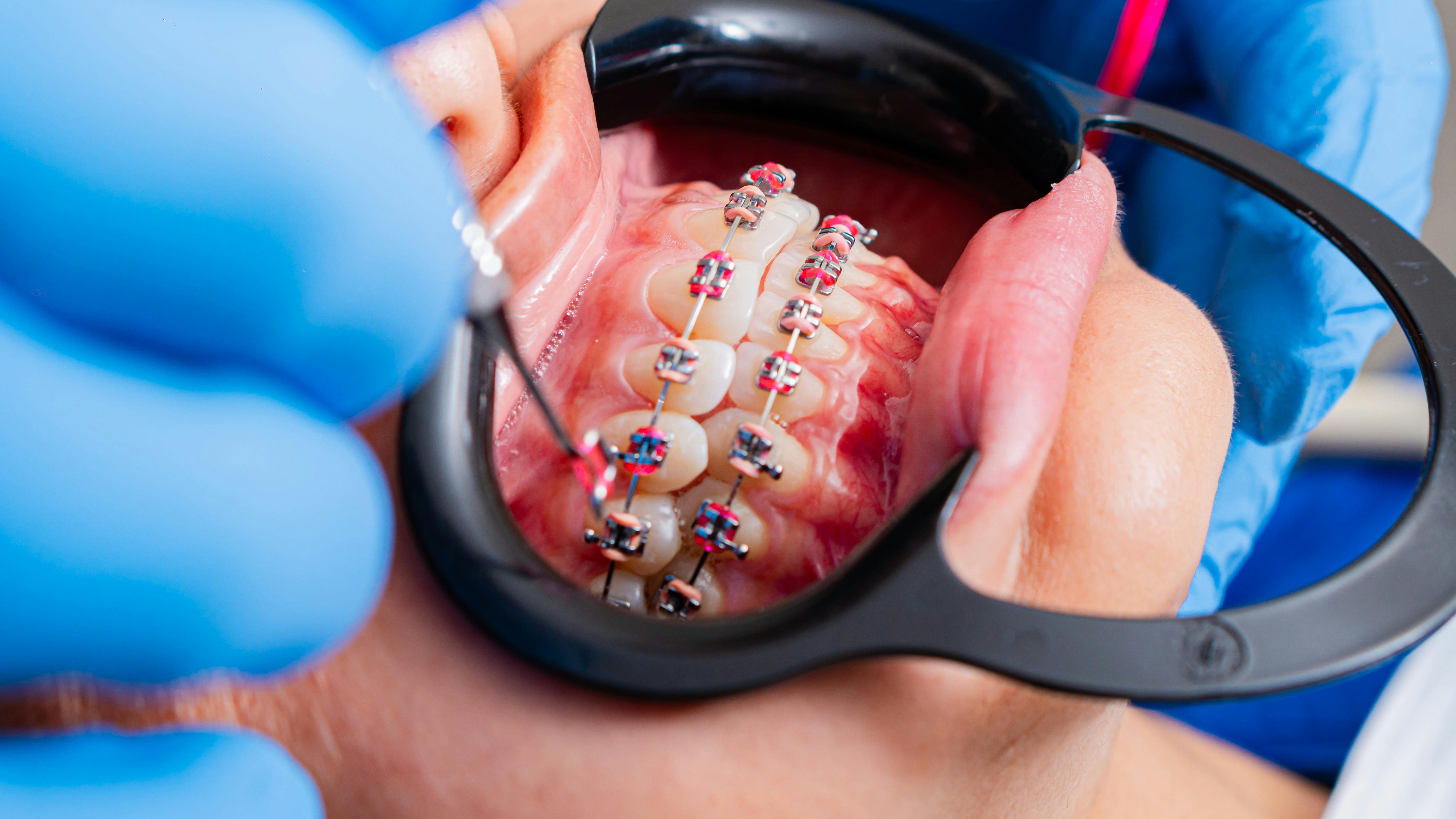 Prudentoe Dental Braces home visit in Hyderabad