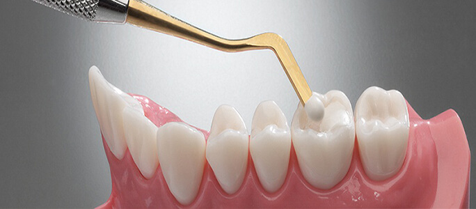 Prudentoe Composite Fillings home visit in Hyderabad