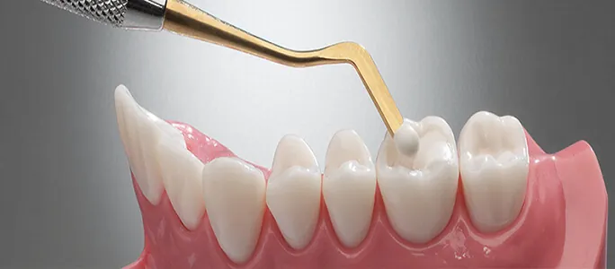 Prudentoe dentist placing a shade-matched tooth-coloured composite filling at a patient's home in Hyderabad