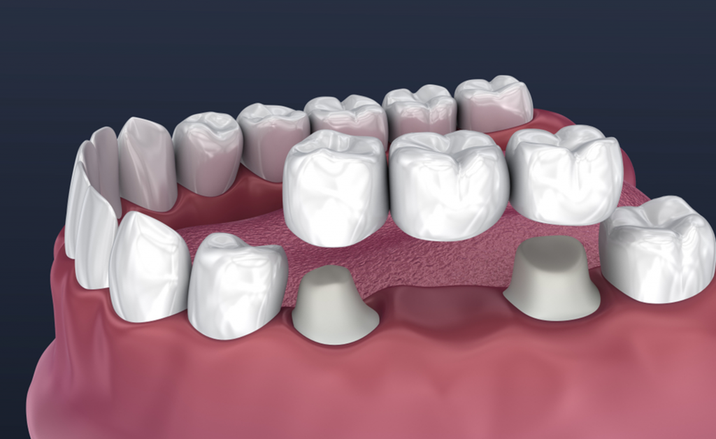 Prudentoe Dental Bridges home visit in Hyderabad