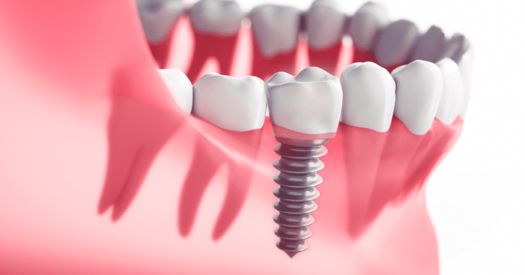Prudentoe Dental Implants home visit in Hyderabad