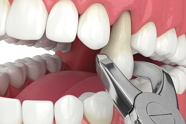 Prudentoe Tooth Extraction home visit in Hyderabad